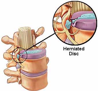 herniated disk